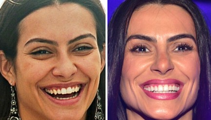 Cleo Pires - Antes e Depois: Gengivectomia