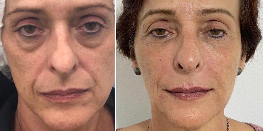 Preenchimento Full Face | Maíra Platero